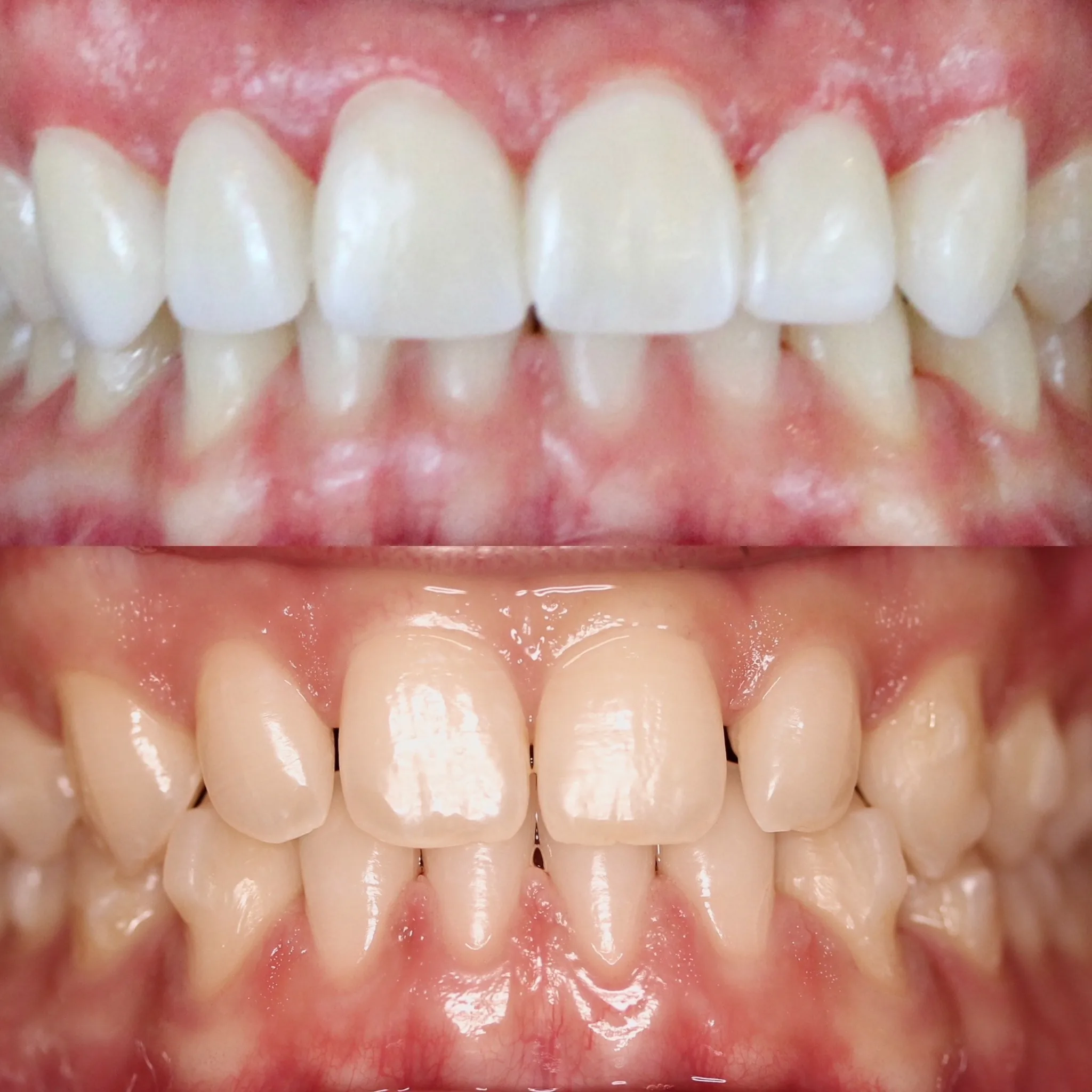 Porcelain Veneers & No-Drill Veneers by Dr. Pia Lieb at Cosmetic Dentistry Center NYC — photo 3