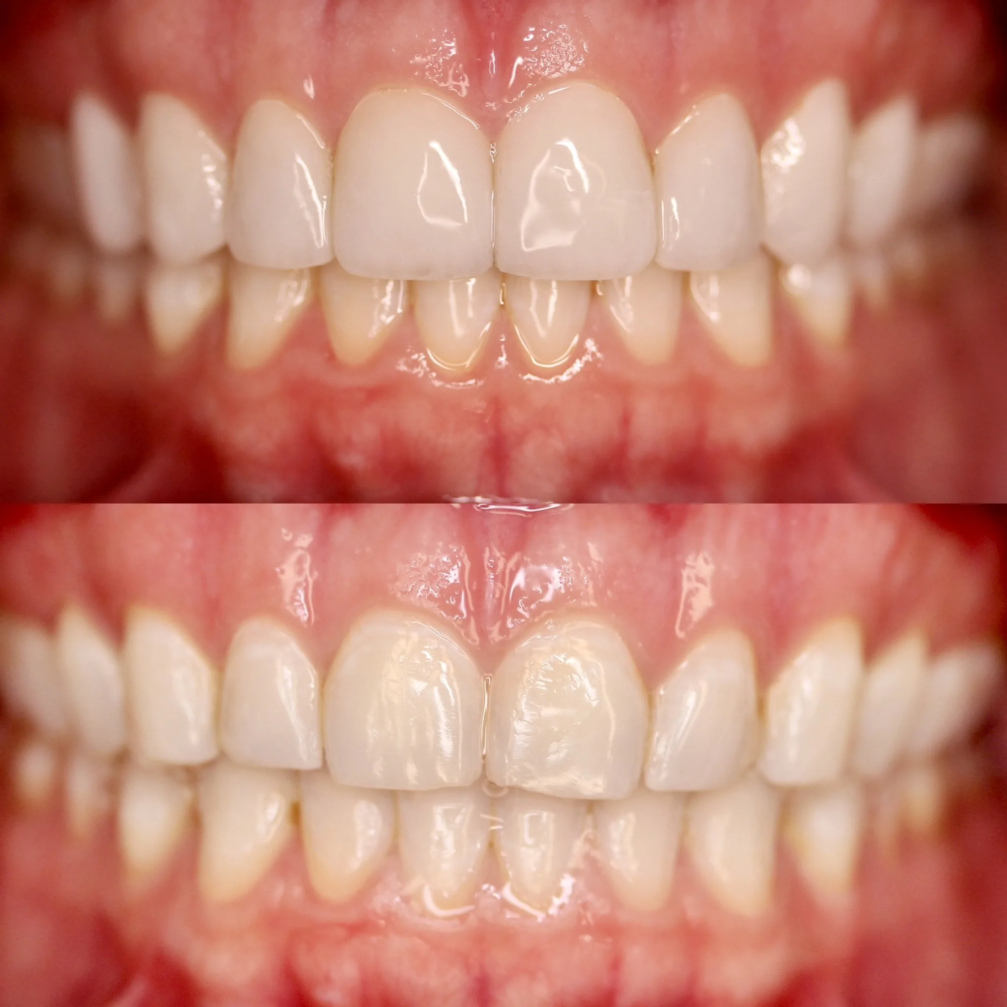 Porcelain Veneers & No-Drill Veneers by Dr. Pia Lieb at Cosmetic Dentistry Center NYC — photo 4