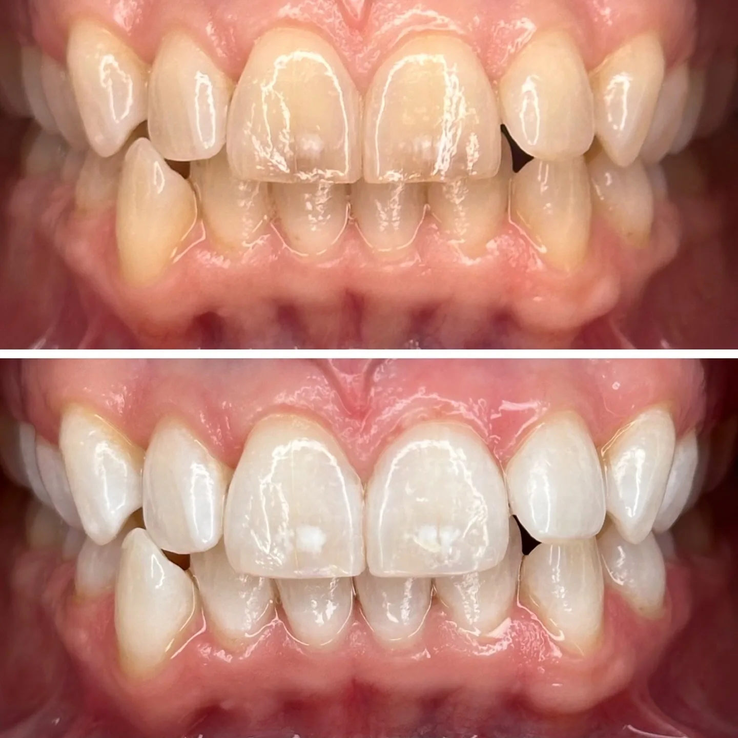 LaserSmile™ Teeth Whitening by Dr. Pia Lieb at Cosmetic Dentistry Center NYC — photo 3