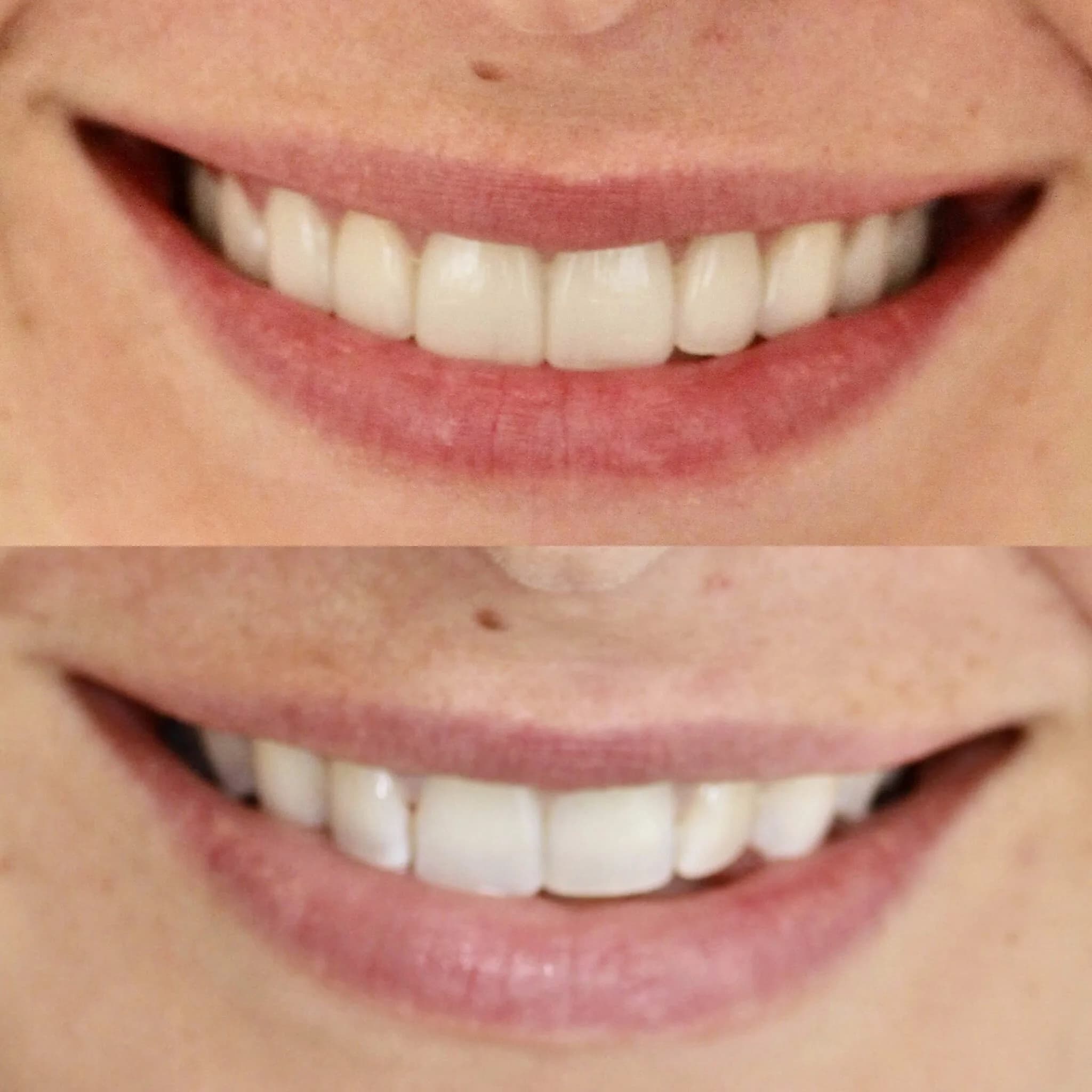 Porcelain Veneers & No-Drill Veneers by Dr. Pia Lieb at Cosmetic Dentistry Center NYC — photo 5