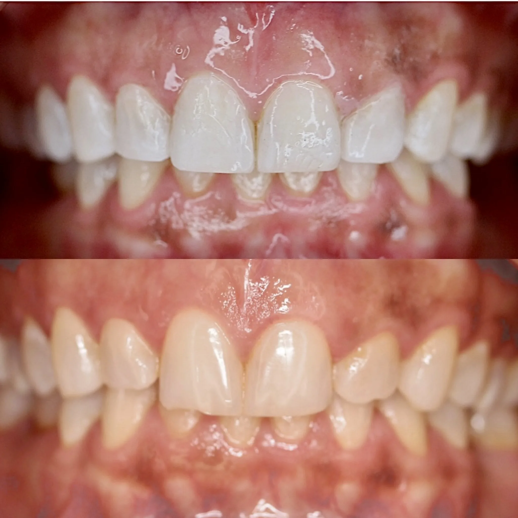 Porcelain Veneers & No-Drill Veneers by Dr. Pia Lieb at Cosmetic Dentistry Center NYC — photo 6