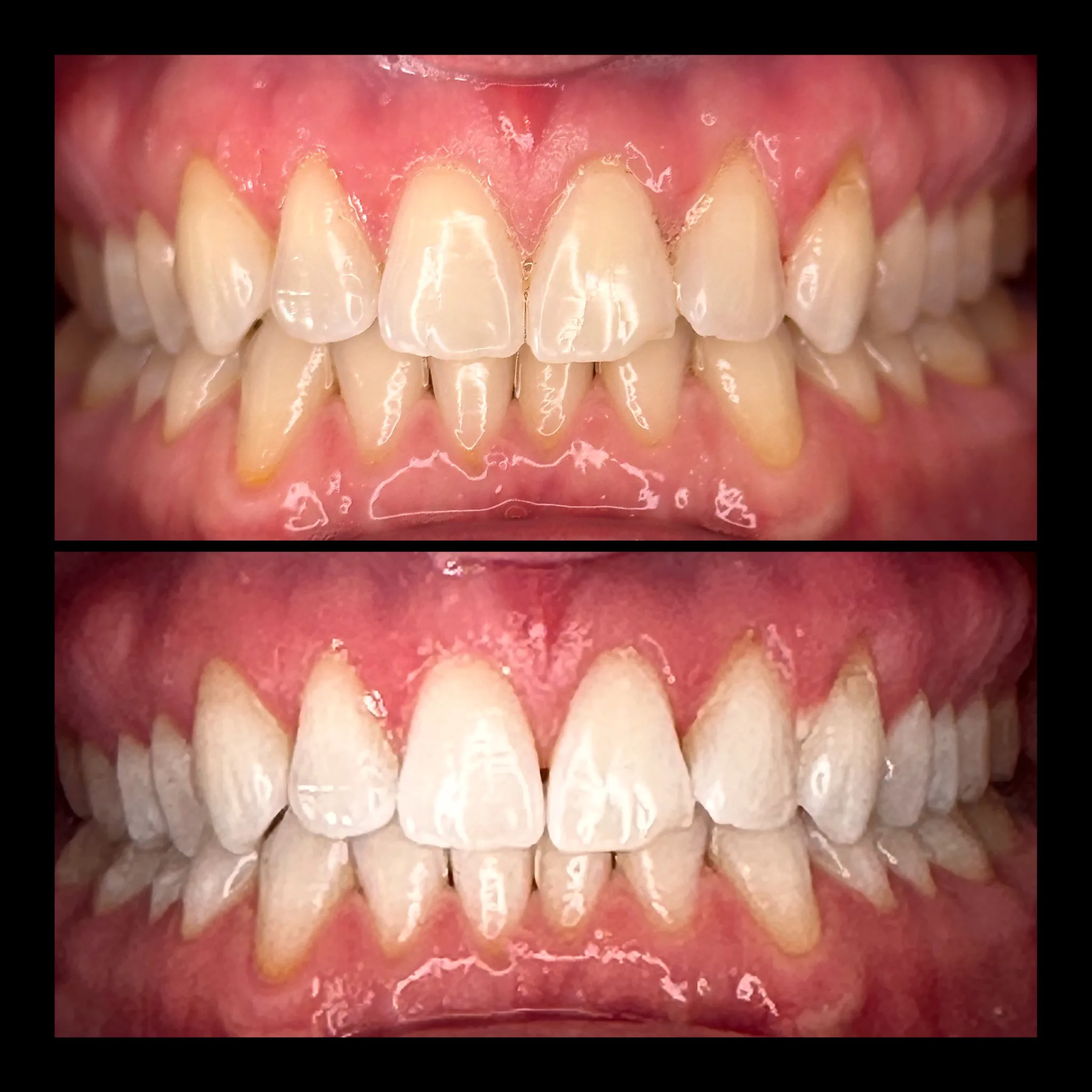 LaserSmile™ Teeth Whitening by Dr. Pia Lieb at Cosmetic Dentistry Center NYC — photo 1