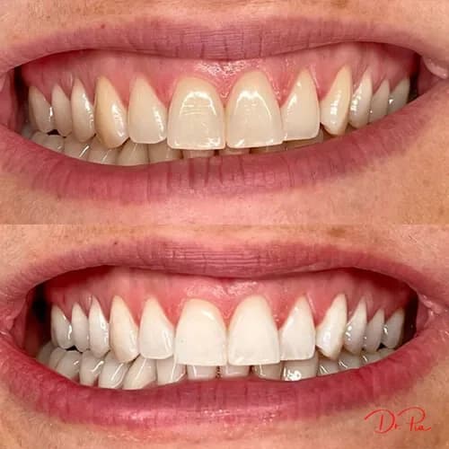 Receding Gums: Why It Happens and Can You Reverse It?