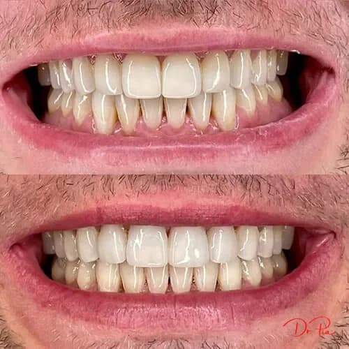 Is It Normal for Kids to Grind Their Teeth at Night?