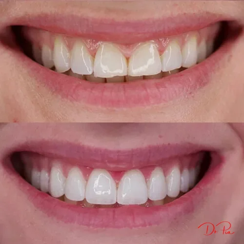 Does Oil Pulling Actually Work? Natural Teeth Whitening, Examined