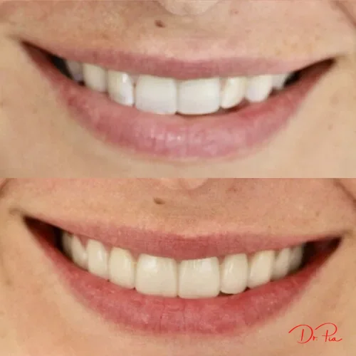 Wisdom Teeth Removal: Do You Actually Need It?
