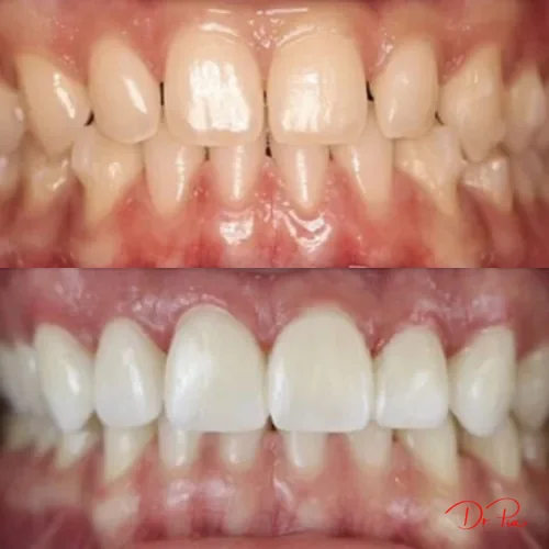 What Is a Smile Makeover? Your Cosmetic Dentistry Options Explained