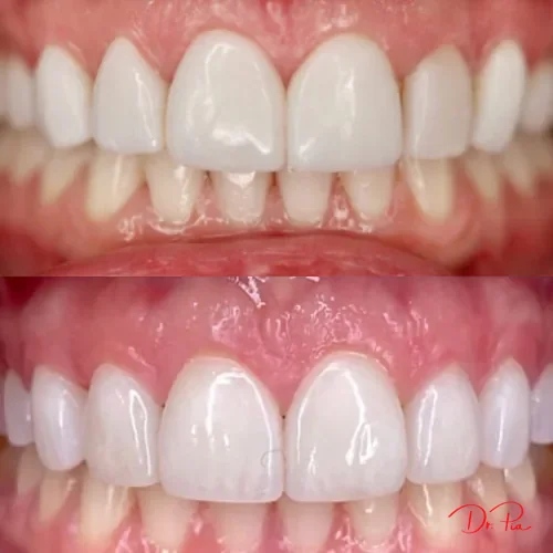 Tooth Reshaping: The Subtle Cosmetic Fix You've Never Heard Of