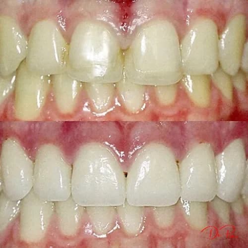At-Home vs. In-Office Clear Aligners: What's the Difference?