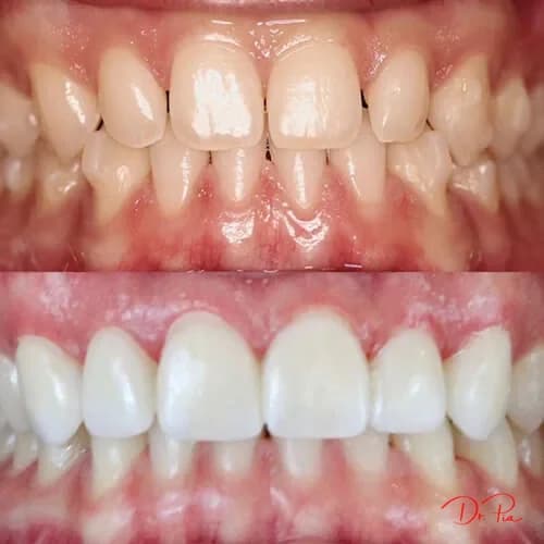 White Spots on Your Teeth? Causes and How to Remove Them