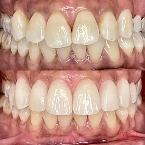 How to Make Your Cosmetic Dental Work Last