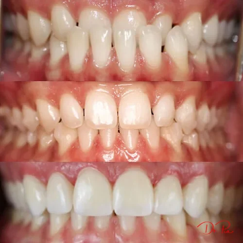 Same-Day Crowns: How 3D Printing Is Changing Dental Visits