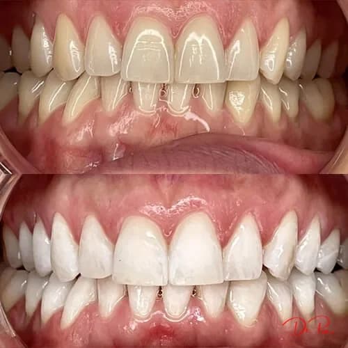 Dark Gums? What Gum Depigmentation Can (and Can't) Do