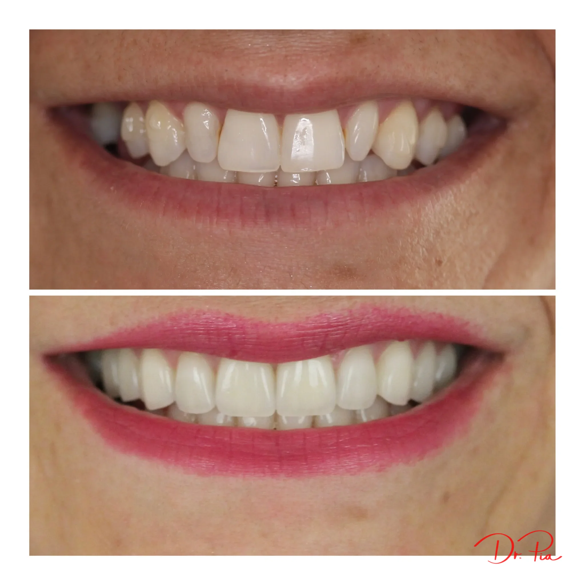 The Surprising Link Between Diabetes and Gum Disease