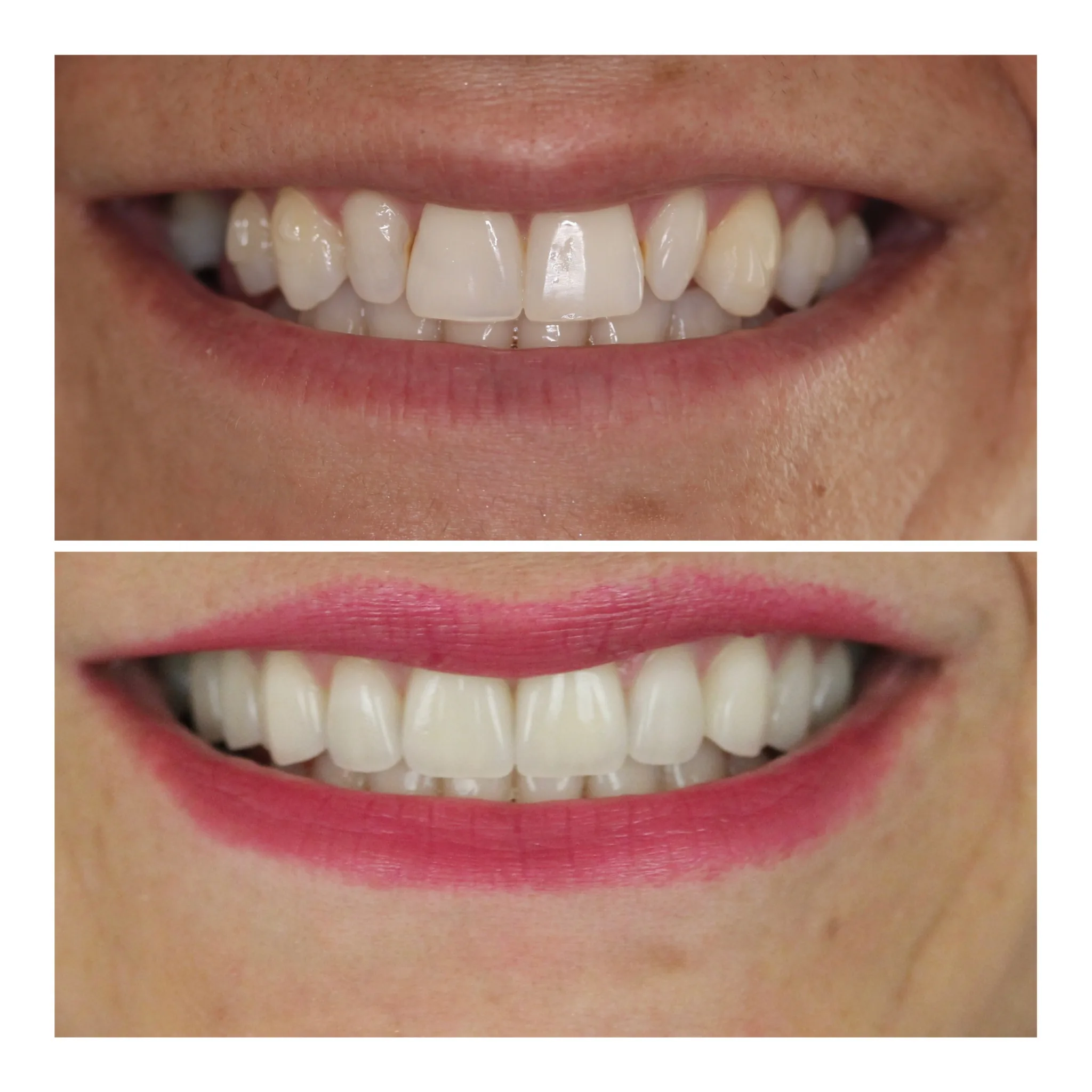 Dental Implants in NYC by Dr. Pia Lieb at Cosmetic Dentistry Center NYC — photo 1