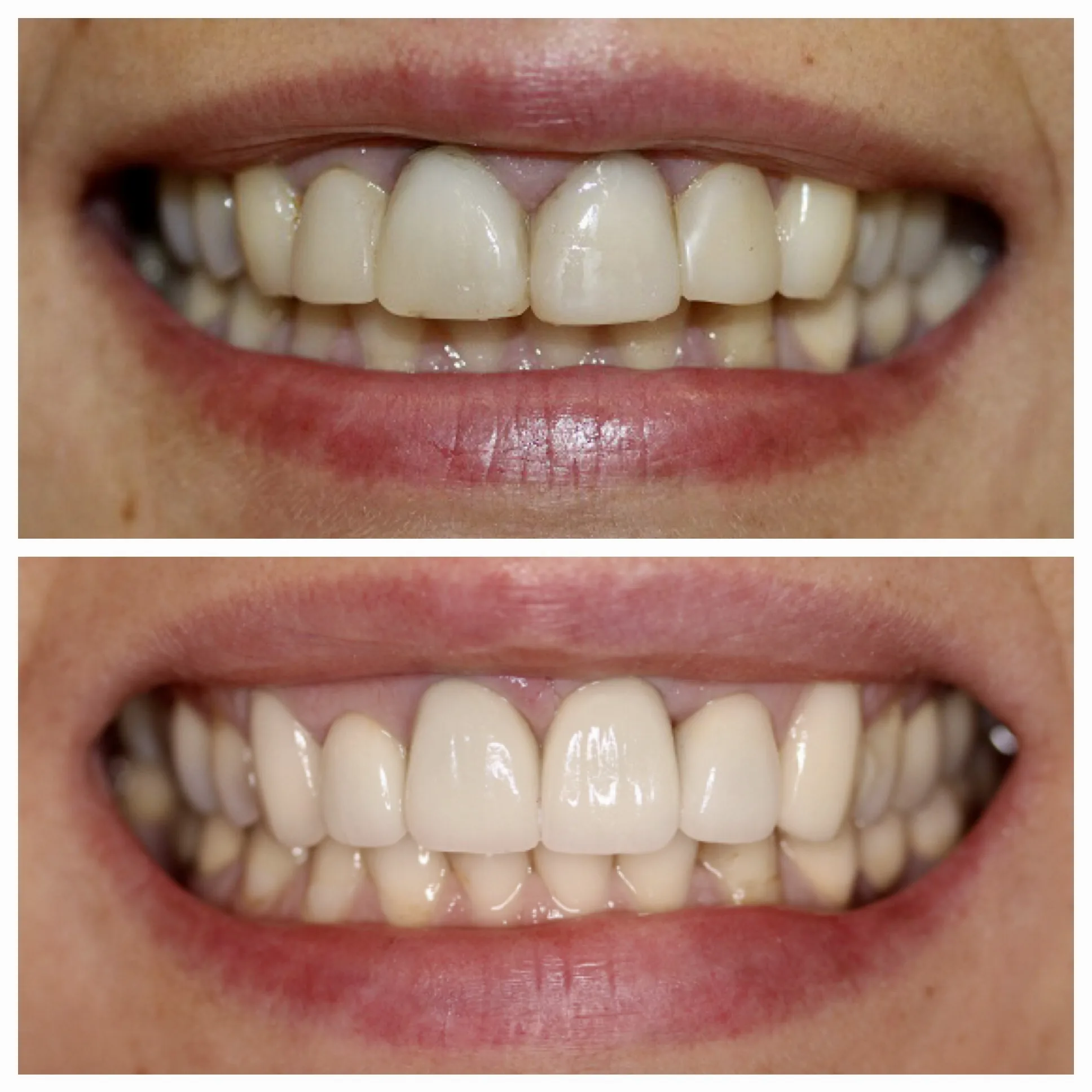 Dental Implants in NYC by Dr. Pia Lieb at Cosmetic Dentistry Center NYC — photo 3