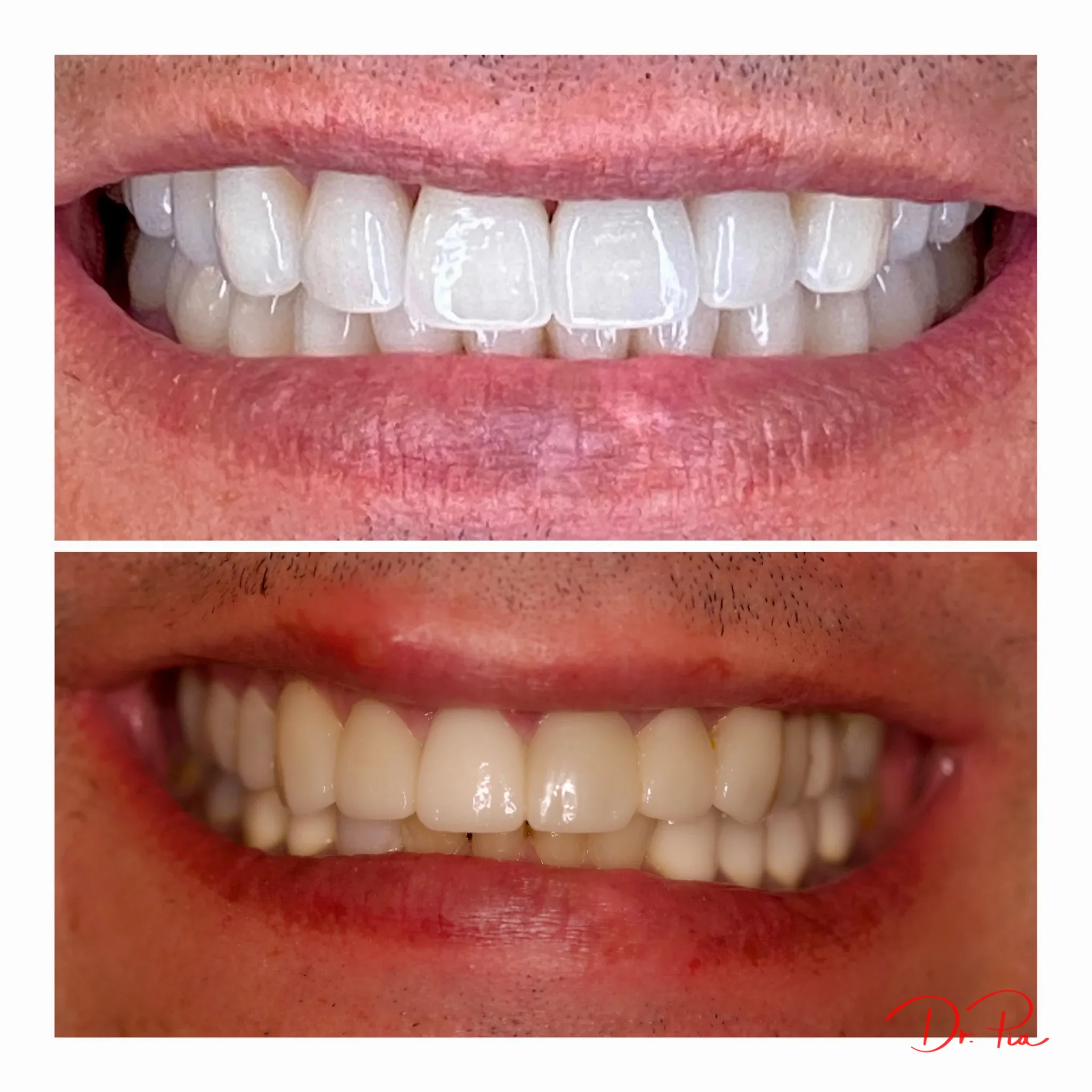 Cracked or Chipped a Tooth? Here's What to Do Right Now