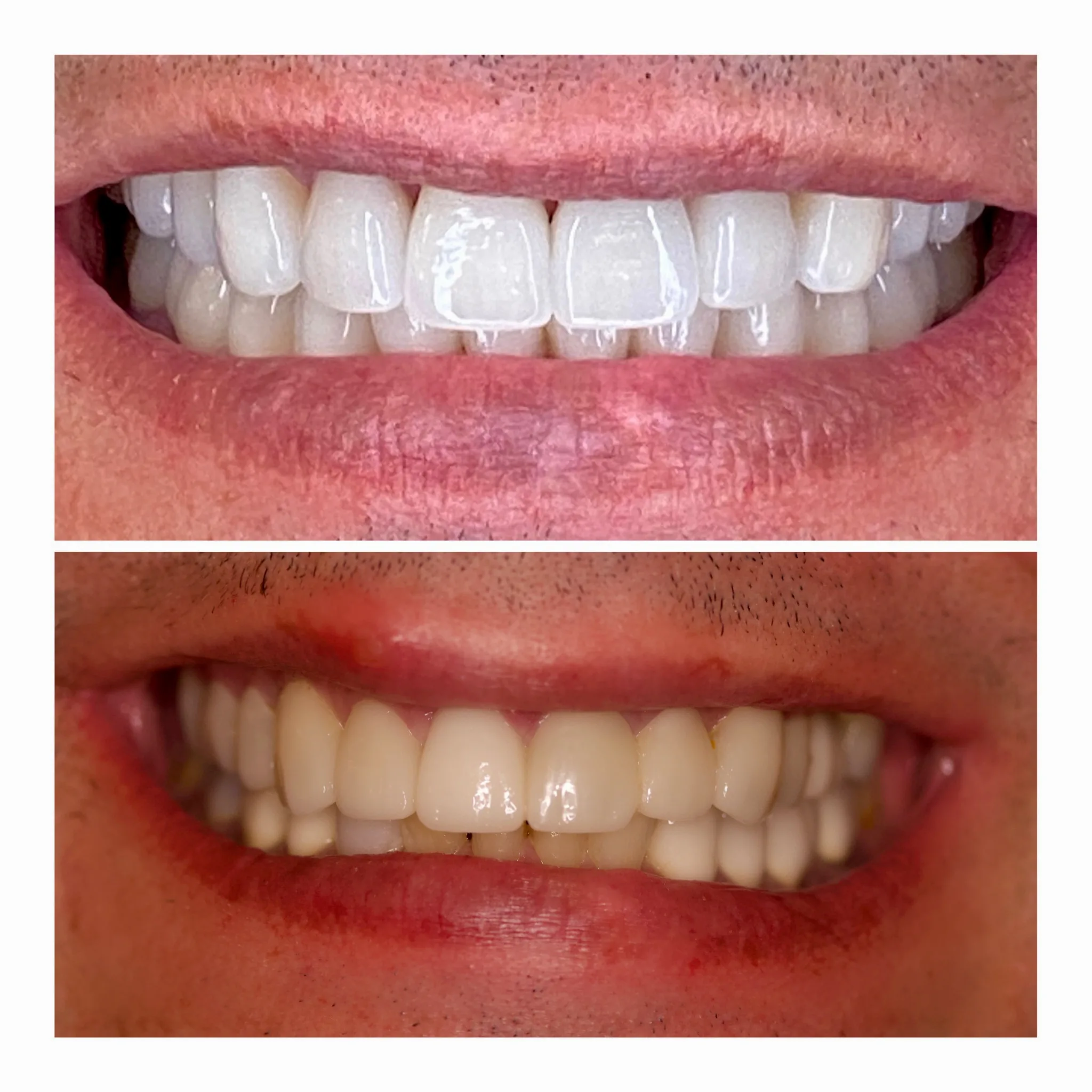 Dental Implants in NYC by Dr. Pia Lieb at Cosmetic Dentistry Center NYC — photo 2