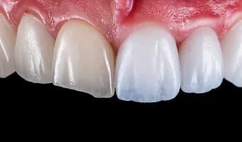 No-drill Veneers — cosmetic dentistry service at Cosmetic Dentistry Center NYC