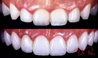 Gummy Smile? Here's How Gum Contouring Can Help
