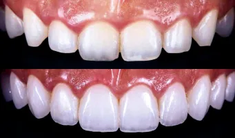 Gum Design — cosmetic dentistry service at Cosmetic Dentistry Center NYC