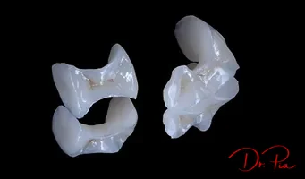 Inlays and Onlays: The Middle Ground Between Fillings and Crowns