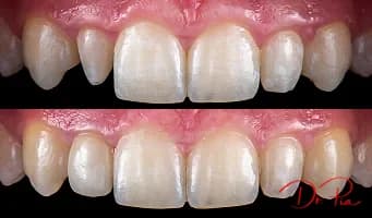 Dental Bonding: The Affordable Fix for Chips, Gaps, and Stains