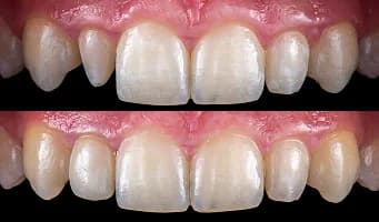 Dental Bonding — cosmetic dentistry service at Cosmetic Dentistry Center NYC