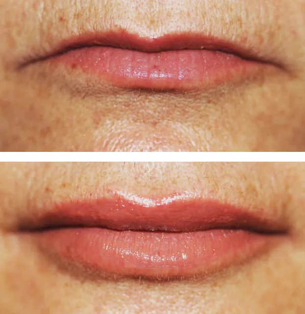 Lip Filler in NYC: cosmetic dentistry service at Cosmetic Dentistry NYC