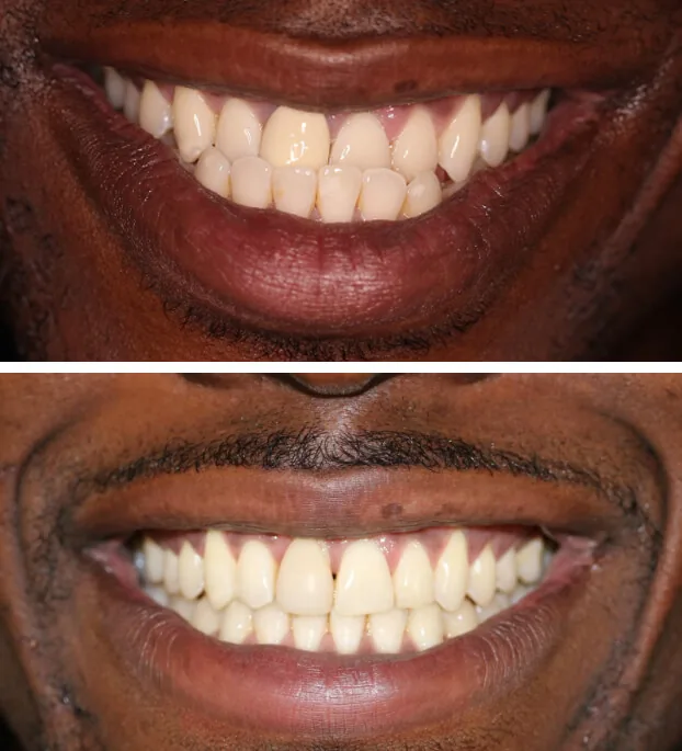 Invisalign case by Dr. Pia Lieb at Cosmetic Dentistry NYC: photo 4