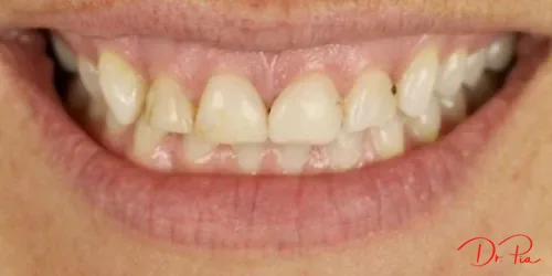 Teeth Whitening: What Actually Works and What Doesn't