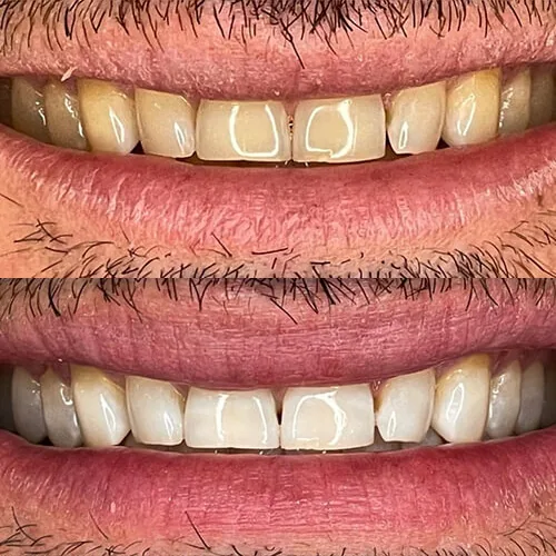 Before-and-after smile transformation by Dr. Pia Lieb at Cosmetic Dentistry NYC, case 7