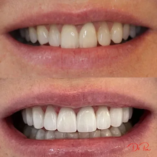 Tooth Extraction Aftercare: What to Do Day by Day