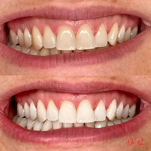 Receding Gums: Why It Happens and Can You Reverse It?