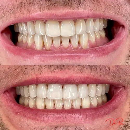 Is It Normal for Kids to Grind Their Teeth at Night?
