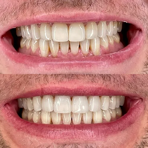 Before-and-after smile transformation by Dr. Pia Lieb at Cosmetic Dentistry NYC, case 14