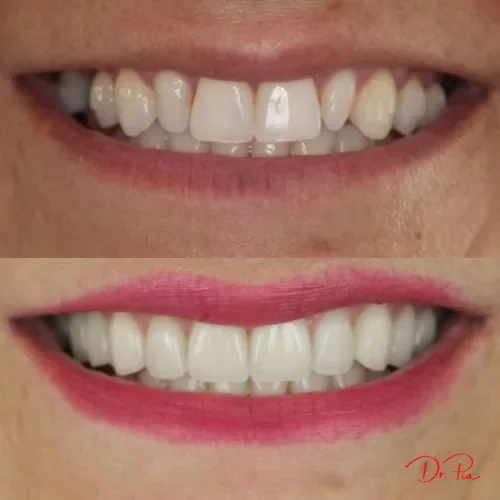 Dental Bridges vs. Implants for a Missing Tooth