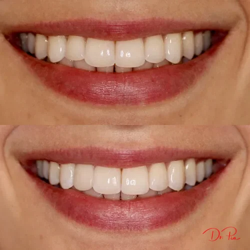 Is a Root Canal Really That Painful? What to Actually Expect: Cosmetic Dentistry NYC blog