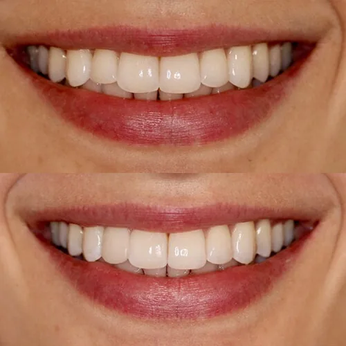 Before-and-after smile transformation by Dr. Pia Lieb at Cosmetic Dentistry NYC, case 16