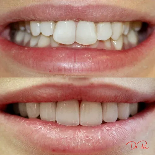 Why Do My Gums Bleed When I Brush? It's Not Normal: Cosmetic Dentistry NYC blog