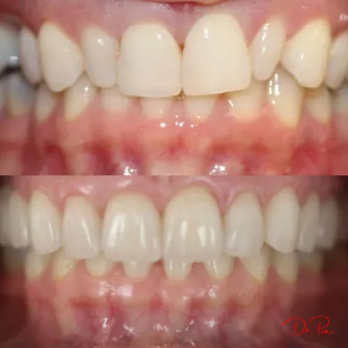 Dental Implants 101: How the Process Works