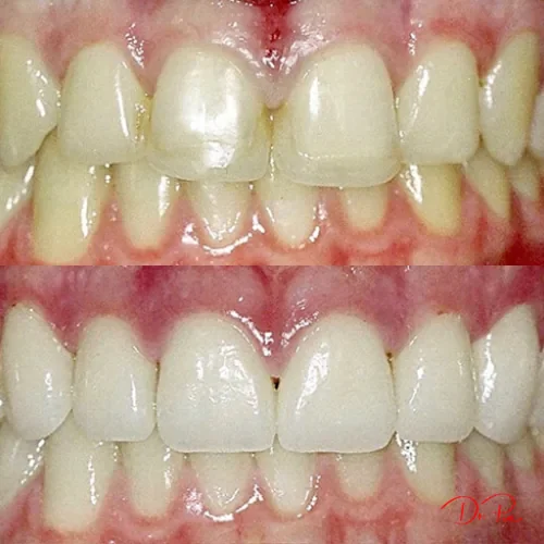 At-Home vs. In-Office Clear Aligners: What's the Difference?