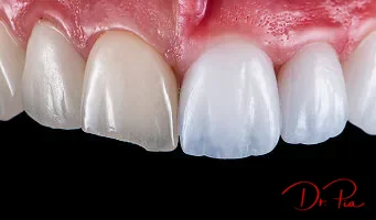 Snap-On / Removable Veneers: Do They Actually Work?: Cosmetic Dentistry NYC blog